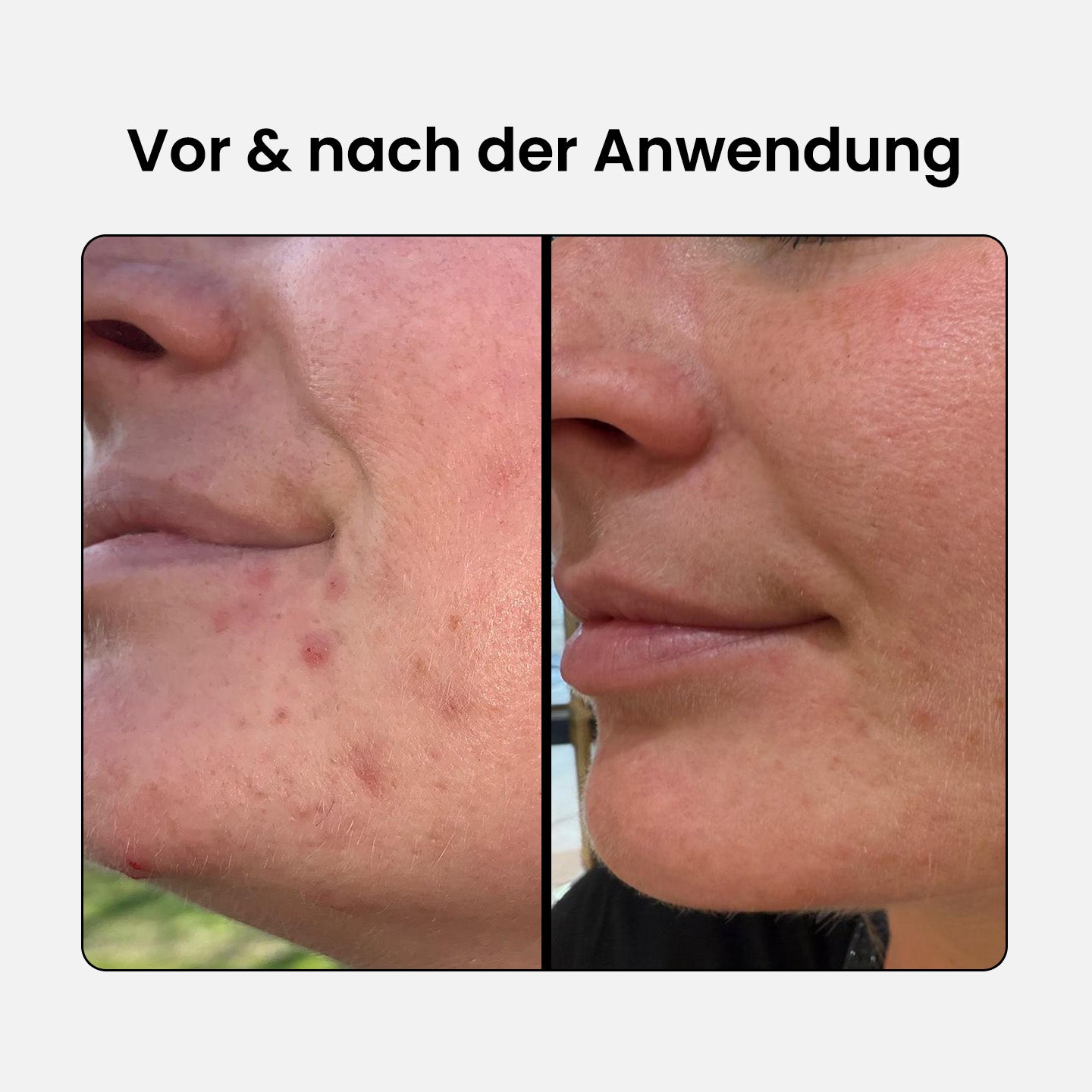 2% BHA Salicylsäure Serum